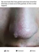 Facial Genital Warts