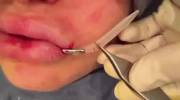 Bolted on lips surgery lip implants