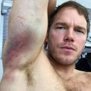Chris Pratt showing off his... bruise