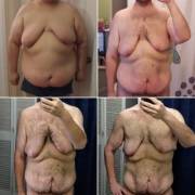 36M - 17 months progress, -202 lbs, hope to get chest surgery soon