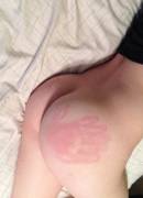 This girl got spanked such that it looks as though her spanker has an extra finger [x-post from /r/mildlyinteresting/]