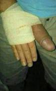 Back from the ER. Broken thumb.