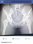 Girl posts x-ray to facebook