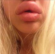 Swollen fake lips